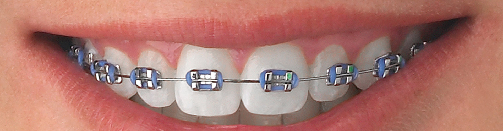 Orthodontic Treatment Services Howick Dental Surgery, Auckland, NZ