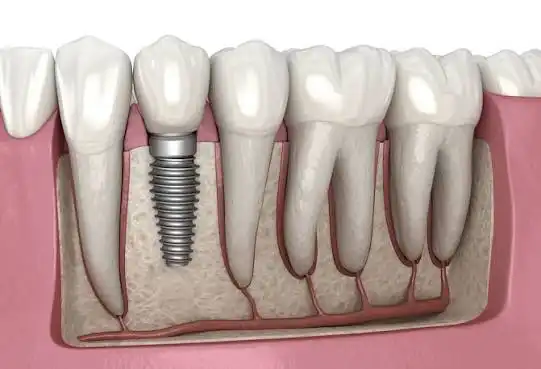 Dental Implant Package